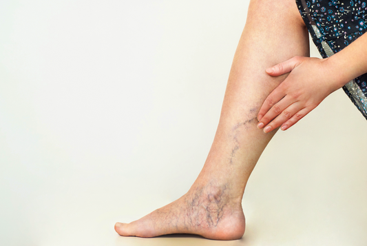 Managing Varicose Veins with Compression Socks